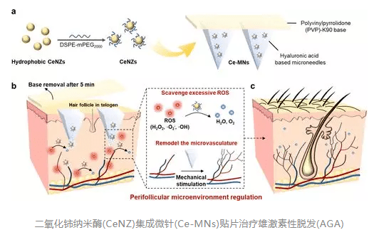 ACS Nano：二氧化铈纳米酶集成微针贴片可以治疗雄激素源性脱发
